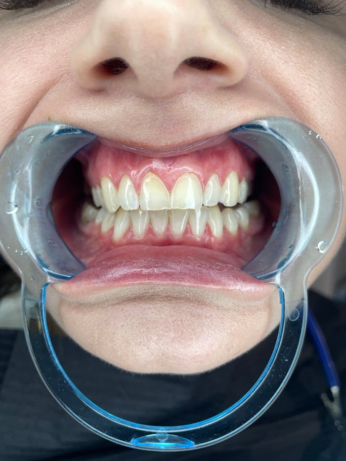 Detailed view of teeth during a dental checkup using a retractor device.